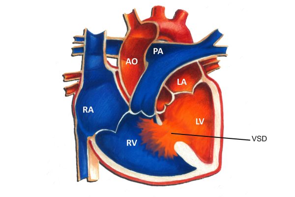 VSD